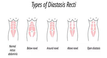 Diastasis Recti: 3 effective and simple ways to improve your ab separation